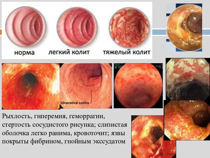 Рыхлость, гиперемия, геморрагии, стертость сосудистого рисунка; слизистая оболочка легко ранима, кровоточит; язвы покрыты фибрином, гнойным экссудатом