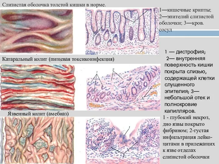 Слизистая оболочка толстой кишки в норме. 1—кишечные крипты; 2—эпителий слизистой