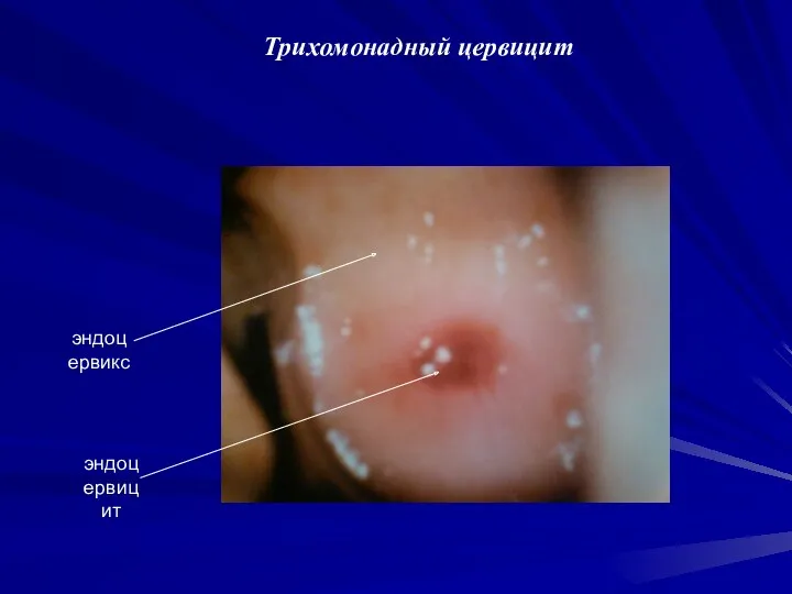 Трихомонадный цервицит эндоцервикс эндоцервицит