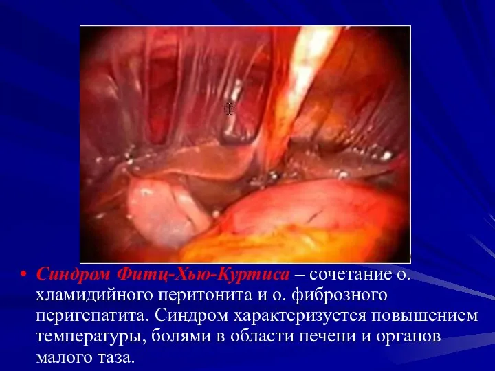 Синдром Фитц-Хью-Куртиса – сочетание о. хламидийного перитонита и о. фиброзного