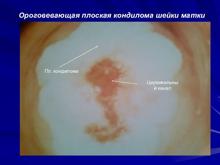 Ороговевающая плоская кондилома шейки матки Пл. кондилома Цервикальный канал