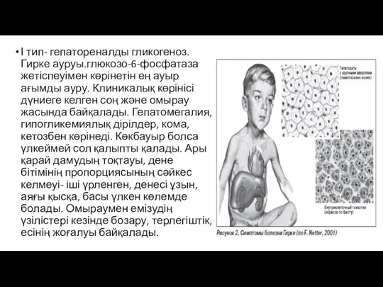 І тип- гепатореналды гликогеноз. Гирке ауруы.глюкозо-6-фосфатаза жетіспеуімен көрінетін ең ауыр ағымды ауру. Клиникалық