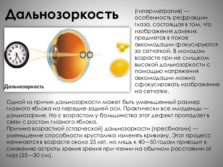 Дальнозоркость (гиперметропия) — особенность рефракции глаза, состоящая в том, что