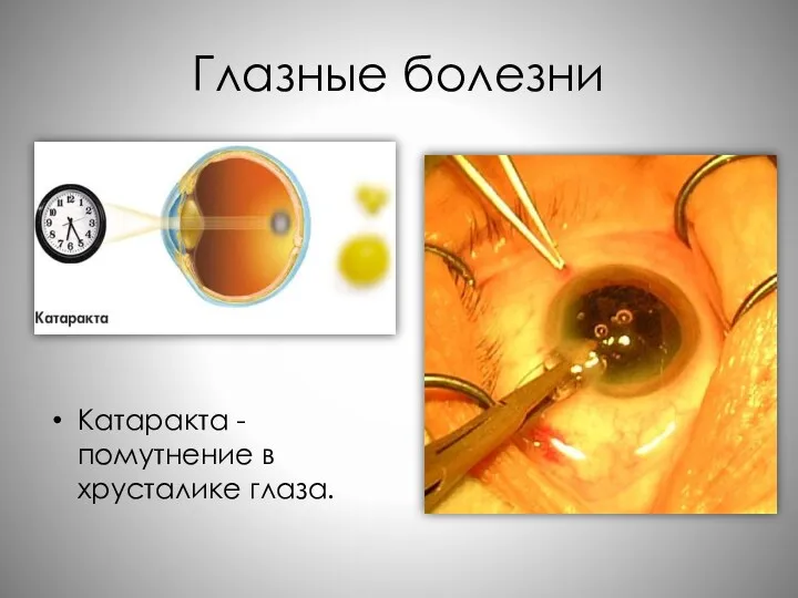Глазные болезни Катаракта - помутнение в хрусталике глаза.