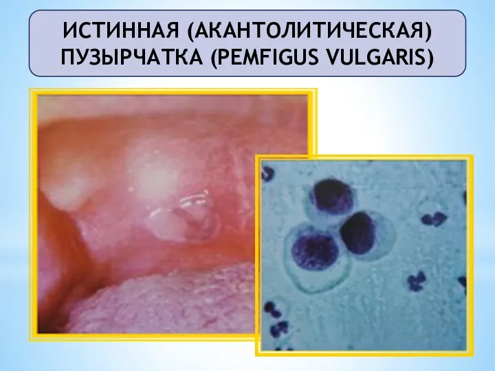 ИСТИННАЯ (АКАНТОЛИТИЧЕСКАЯ) ПУЗЫРЧАТКА (PEMFIGUS VULGARIS)