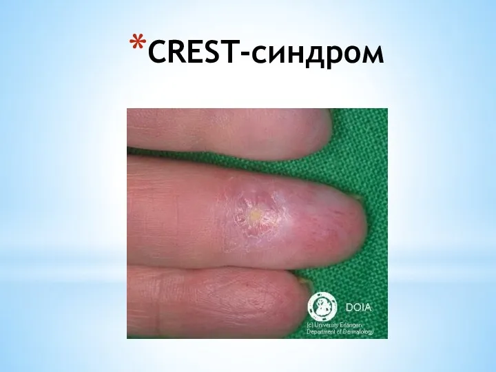 CREST-синдром