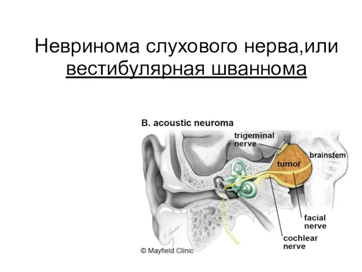 Невринома слухового нерва,или вестибулярная шваннома