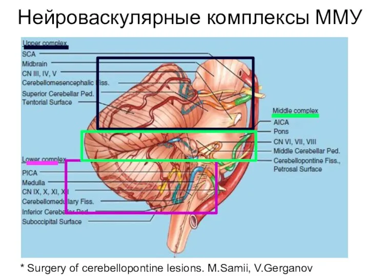 Нейроваскулярные комплексы ММУ * Surgery of cerebellopontine lesions. M.Samii, V.Gerganov
