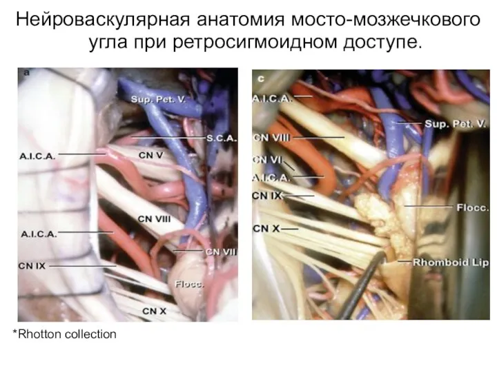 *Rhotton collection Нейроваскулярная анатомия мосто-мозжечкового угла при ретросигмоидном доступе.