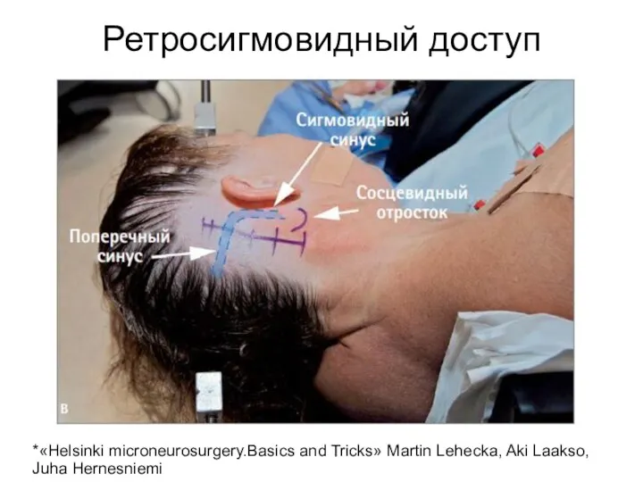 Ретросигмовидный доступ *«Helsinki microneurosurgery.Basics and Tricks» Martin Lehecka, Aki Laakso, Juha Hernesniemi