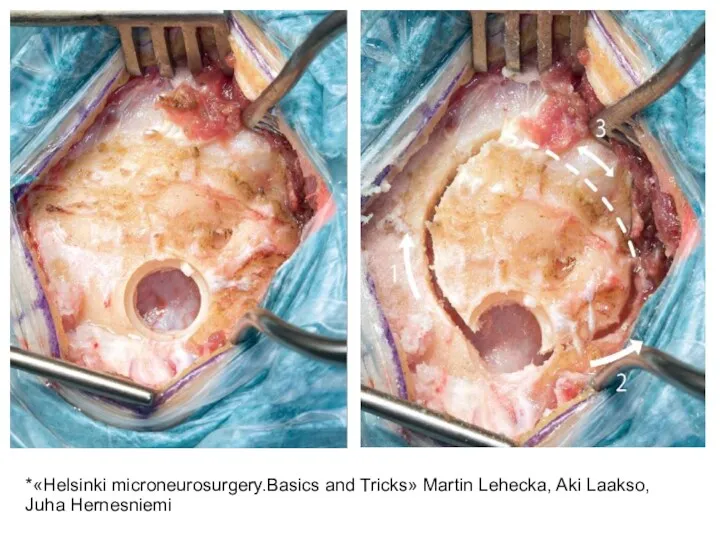 *«Helsinki microneurosurgery.Basics and Tricks» Martin Lehecka, Aki Laakso, Juha Hernesniemi