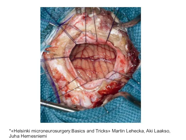 *«Helsinki microneurosurgery.Basics and Tricks» Martin Lehecka, Aki Laakso, Juha Hernesniemi