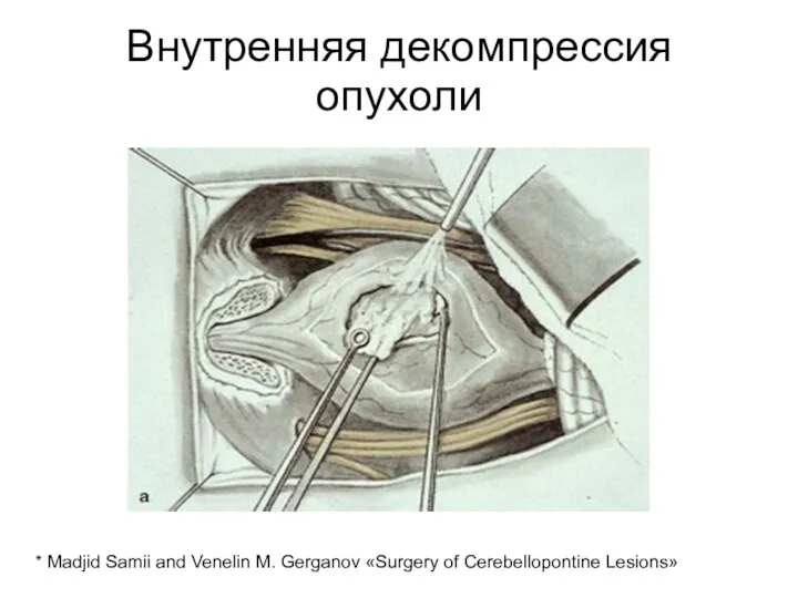 Внутренняя декомпрессия опухоли * Madjid Samii and Venelin M. Gerganov «Surgery of Cerebellopontine Lesions»