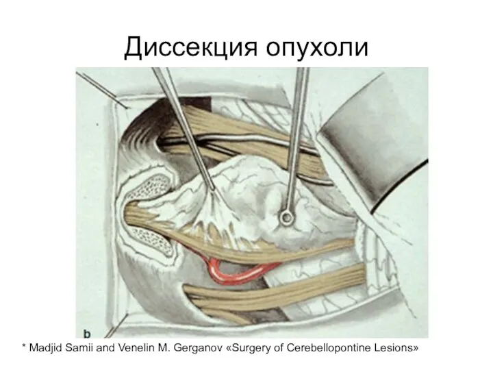 Диссекция опухоли * Madjid Samii and Venelin M. Gerganov «Surgery of Cerebellopontine Lesions»