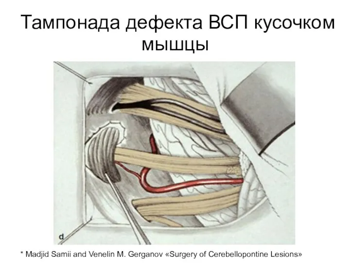 Тампонада дефекта ВСП кусочком мышцы * Madjid Samii and Venelin M. Gerganov «Surgery of Cerebellopontine Lesions»