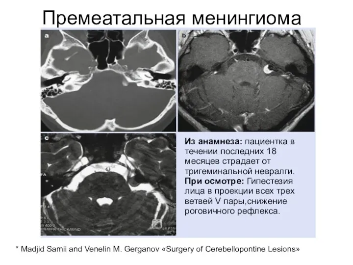 Премеатальная менингиома * Madjid Samii and Venelin M. Gerganov «Surgery