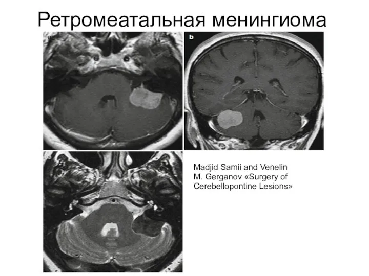 Ретромеатальная менингиома Madjid Samii and Venelin M. Gerganov «Surgery of Cerebellopontine Lesions»
