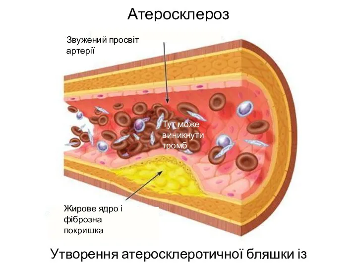 Атеросклероз Утворення атеросклеротичної бляшки із холестерину Жирове ядро і фіброзна