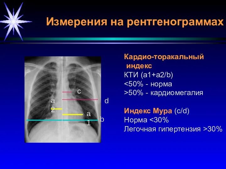 Кардио-торакальный индекс КТИ (a1+a2/b) >50% - кардиомегалия Индекс Мура (c/d) Норма Легочная гипертензия