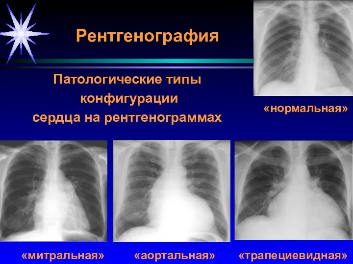 Рентгенография Патологические типы конфигурации сердца на рентгенограммах «митральная» «аортальная» «трапециевидная» «нормальная»