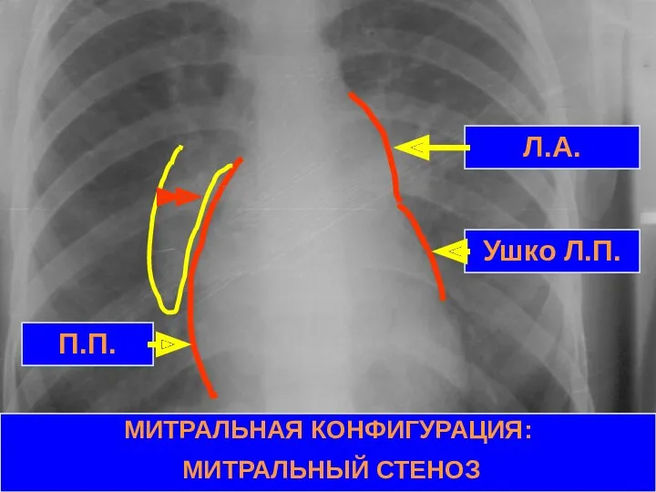 МИТРАЛЬНАЯ КОНФИГУРАЦИЯ: МИТРАЛЬНЫЙ СТЕНОЗ Л.А. Ушко Л.П. П.П.