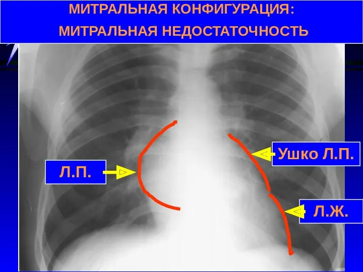 МИТРАЛЬНАЯ КОНФИГУРАЦИЯ: МИТРАЛЬНАЯ НЕДОСТАТОЧНОСТЬ Л.П. Ушко Л.П. Л.Ж.