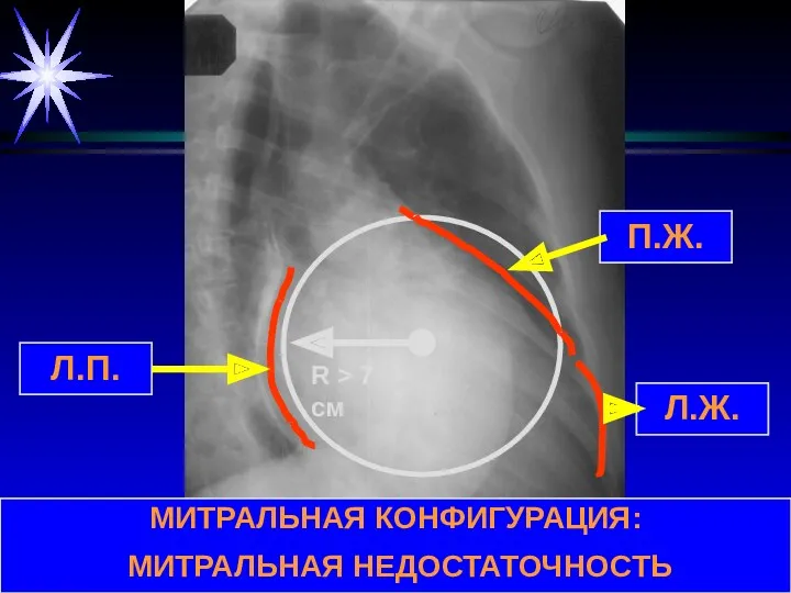 МИТРАЛЬНАЯ КОНФИГУРАЦИЯ: МИТРАЛЬНАЯ НЕДОСТАТОЧНОСТЬ Л.П. R > 7 см П.Ж. Л.Ж.