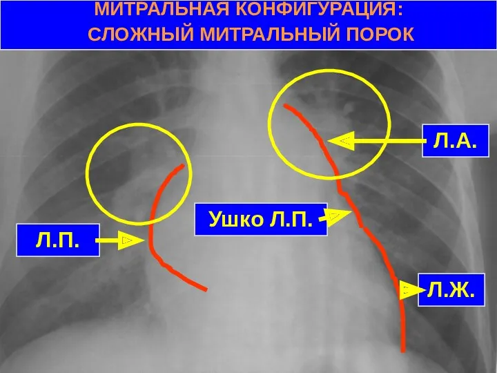 МИТРАЛЬНАЯ КОНФИГУРАЦИЯ: СЛОЖНЫЙ МИТРАЛЬНЫЙ ПОРОК Л.П. Ушко Л.П. Л.А. Л.Ж.