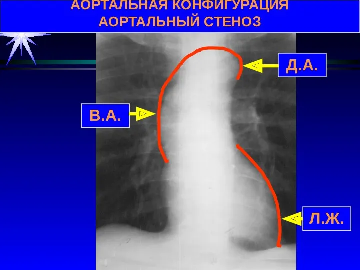 АОРТАЛЬНАЯ КОНФИГУРАЦИЯ АОРТАЛЬНЫЙ СТЕНОЗ В.А. Д.А. Л.Ж.