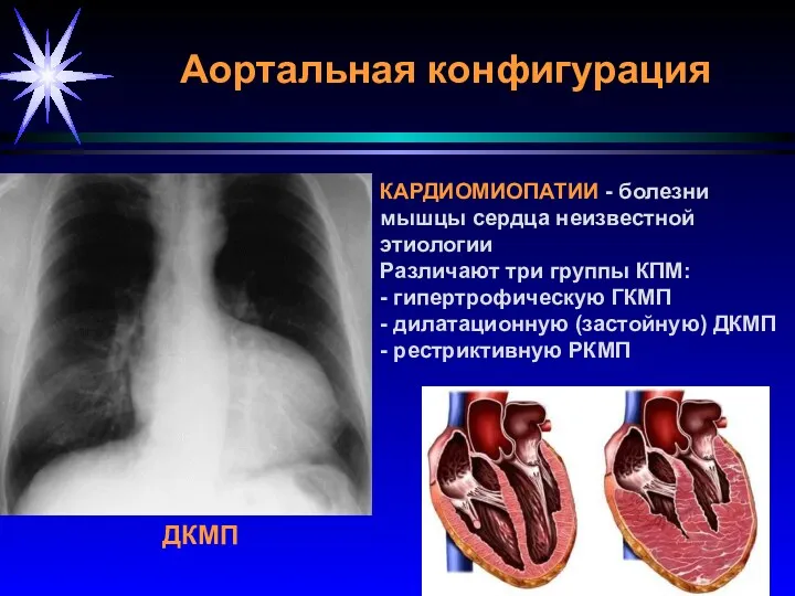 Аортальная конфигурация ДКМП КАРДИОМИОПАТИИ - болезни мышцы сердца неизвестной этиологии