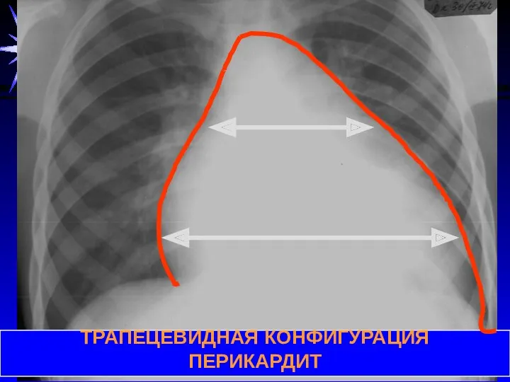 ТРАПЕЦЕВИДНАЯ КОНФИГУРАЦИЯ ПЕРИКАРДИТ