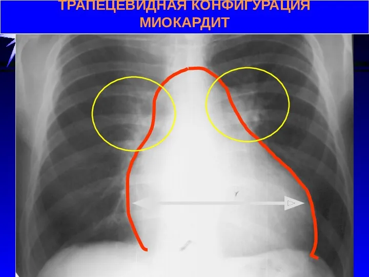 ТРАПЕЦЕВИДНАЯ КОНФИГУРАЦИЯ МИОКАРДИТ