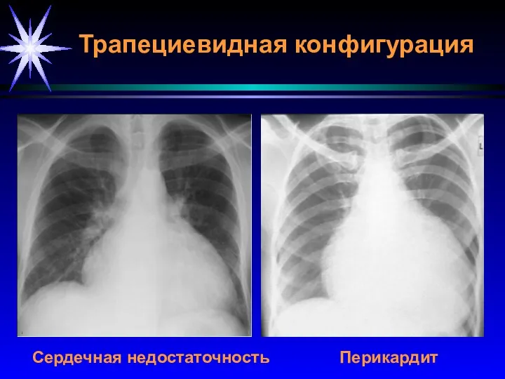 Трапециевидная конфигурация Сердечная недостаточность Перикардит