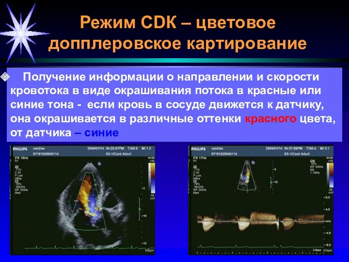 Режим CDК – цветовое допплеровское картирование Получение информации о направлении