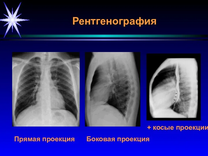 Рентгенография Прямая проекция Боковая проекция + косые проекции