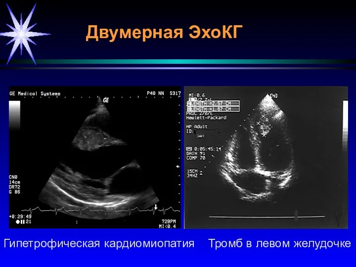 Двумерная ЭхоКГ Гипетрофическая кардиомиопатия Тромб в левом желудочке