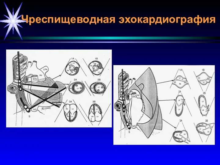 Чреспищеводная эхокардиография