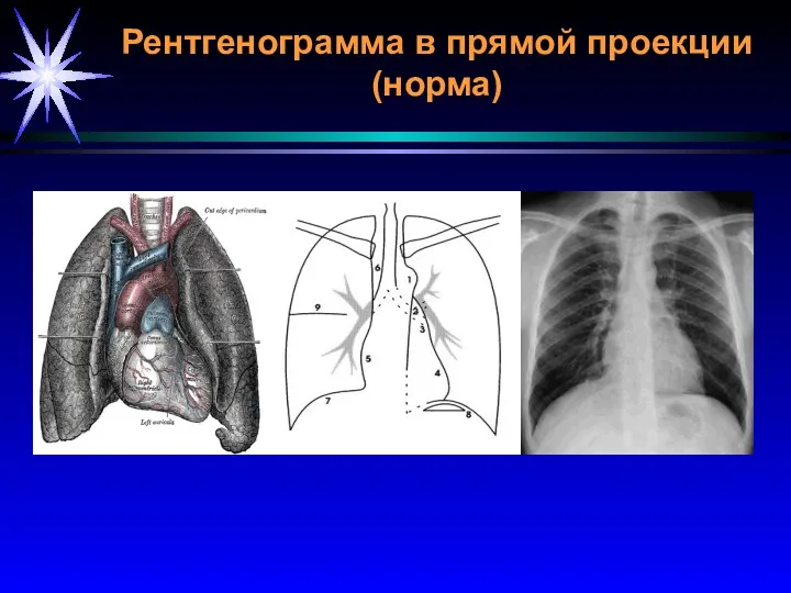 Рентгенограмма в прямой проекции (норма)