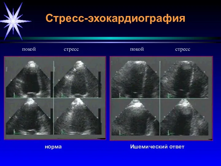 Стресс-эхокардиография норма Ишемический ответ покой стресс покой стресс