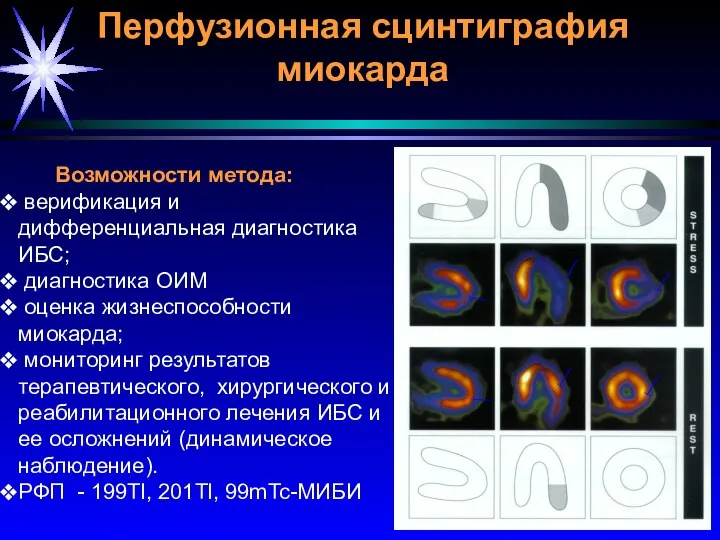 Перфузионная сцинтиграфия миокарда Возможности метода: верификация и дифференциальная диагностика ИБС;