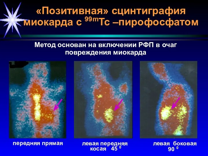«Позитивная» сцинтиграфия миокарда с 99mTc –пирофосфатом левая передняя косая 45 0 передняя прямая