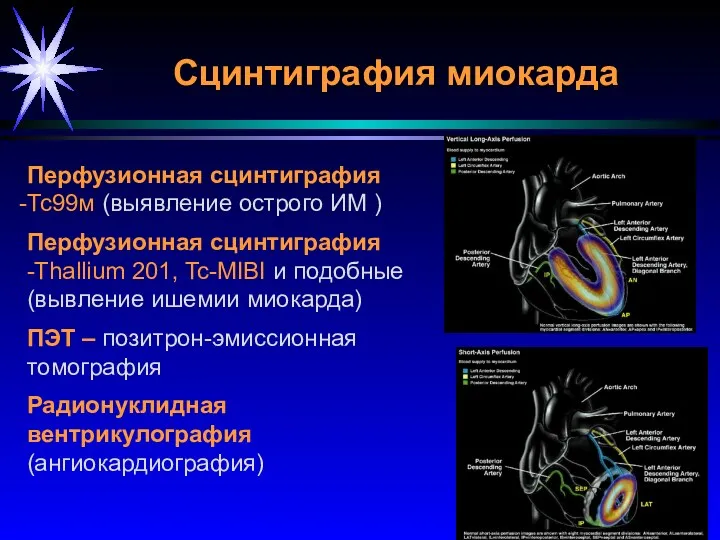 Сцинтиграфия миокарда Перфузионная сцинтиграфия Тс99м (выявление острого ИМ ) Перфузионная