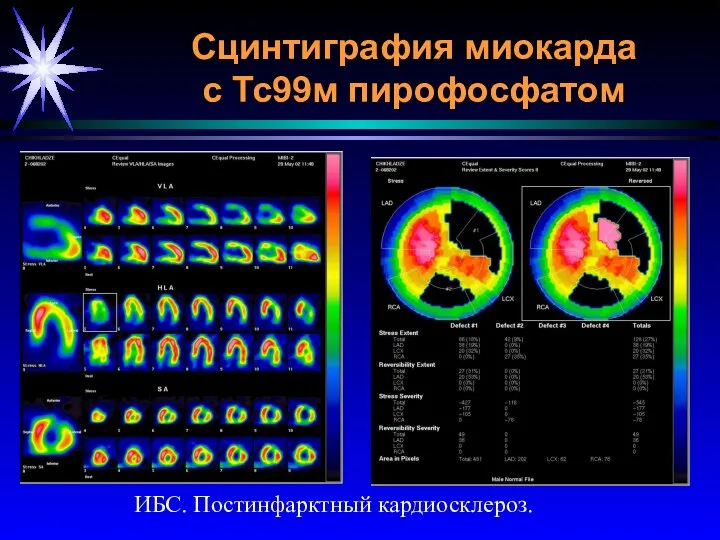 Сцинтиграфия миокарда с Тс99м пирофосфатом ИБС. Постинфарктный кардиосклероз.