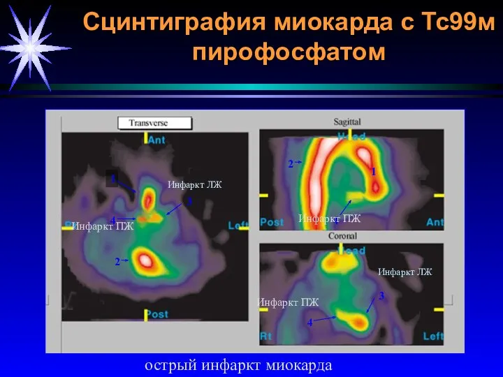 Сцинтиграфия миокарда с Тс99м пирофосфатом Инфаркт ЛЖ Инфаркт ПЖ Инфаркт ПЖ Инфаркт ПЖ