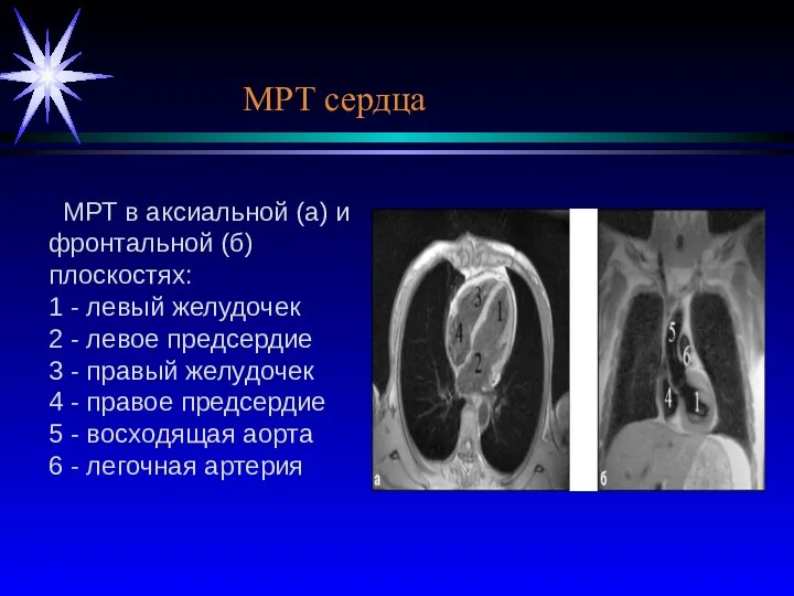 МРТ в аксиальной (а) и фронтальной (б) плоскостях: 1 - левый желудочек 2