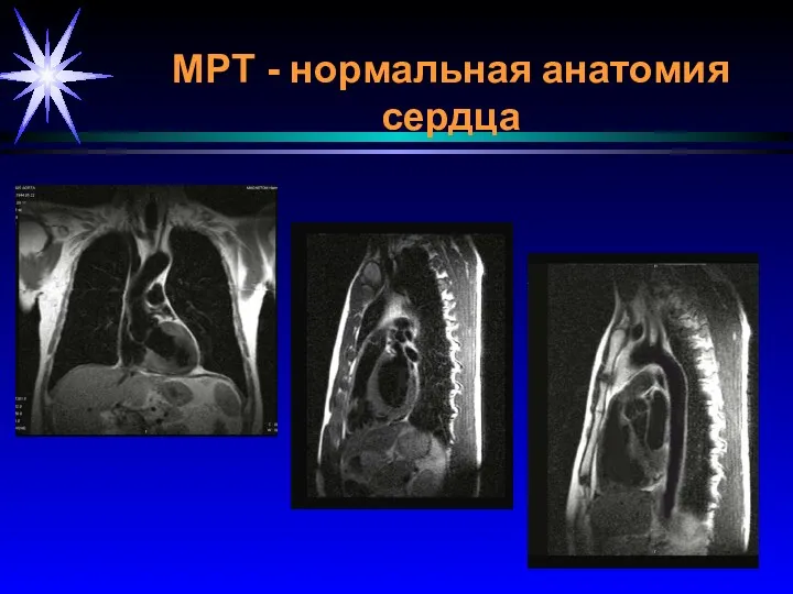МРТ - нормальная анатомия сердца