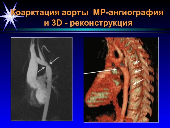 Коарктация аорты МР-ангиография и 3D - реконструкция