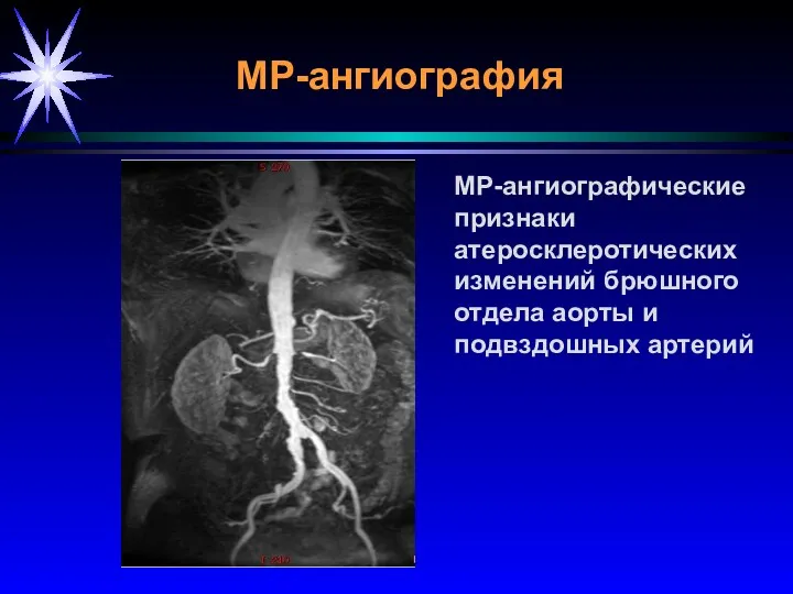 МР-ангиография МР-ангиографические признаки атеросклеротических изменений брюшного отдела аорты и подвздошных артерий