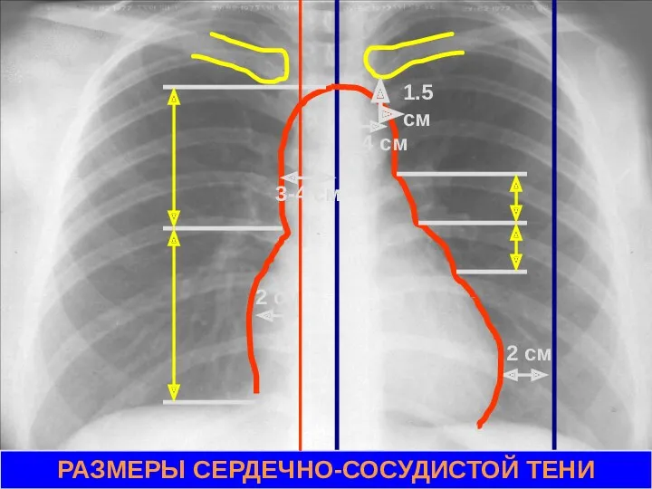 2 см 2 см 1.5 см 3-4 см РАЗМЕРЫ СЕРДЕЧНО-СОСУДИСТОЙ ТЕНИ 3-4 см