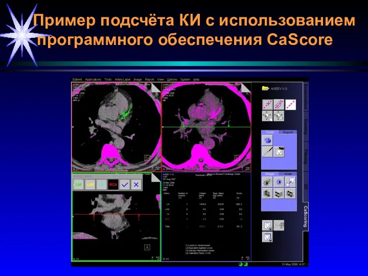 Пример подсчёта КИ с использованием программного обеспечения CaScore